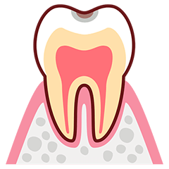 C1 初期の虫歯