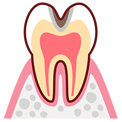C2 歯の内部まで進行した虫歯