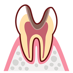 C3 神経まで進行した虫歯