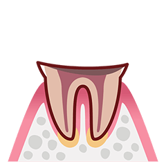 C4 根の部分だけが残った虫歯