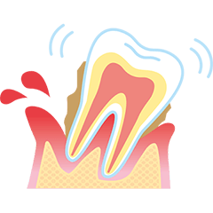 重度の歯周炎
